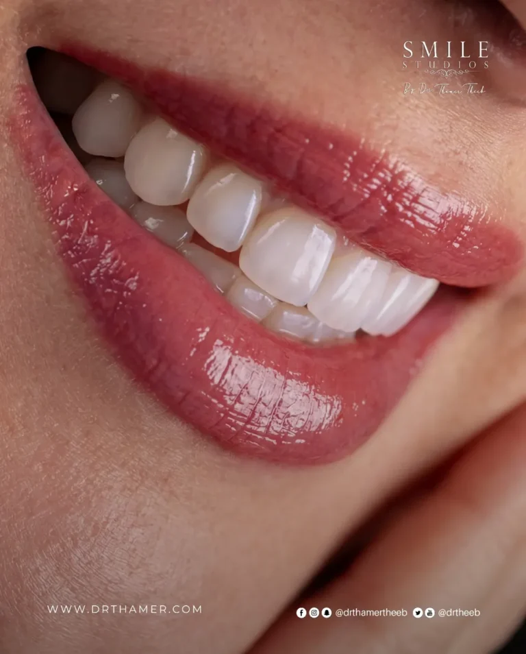 Immediate Dental Implants in Amman