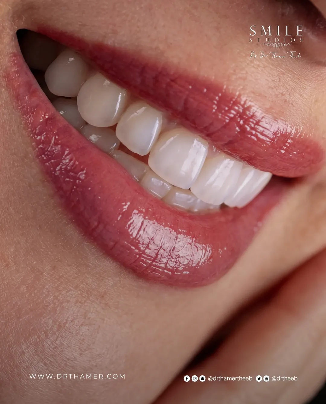 Immediate Dental Implants in Amman